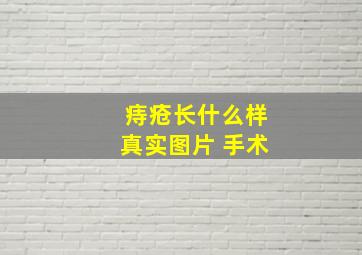 痔疮长什么样真实图片 手术